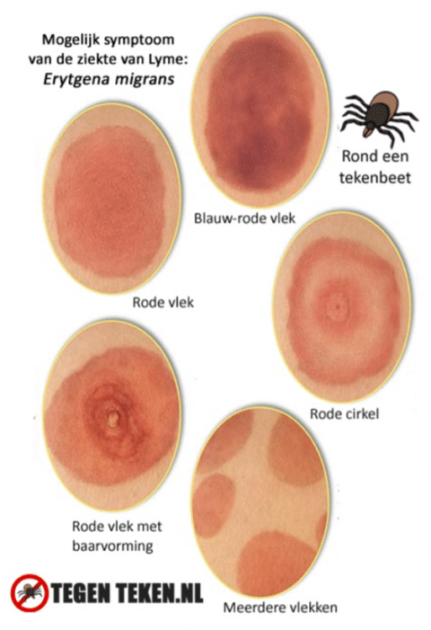 Wat Te Doen Na Een Tekenbeet Lymeherstel